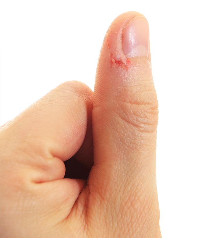 Hangnails: The Ultimate Guide to Flawless Fingers!